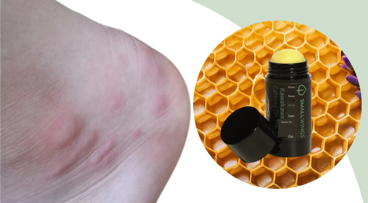 [More Volume!] Get Ready to Win the Mosquito Battle—Summer’s Longer This Year!